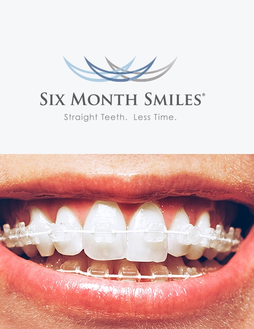 month braces smiles clear six london adults affordable hornchurch essex cost low