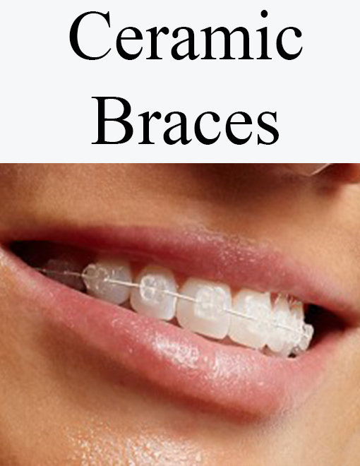 Metal Braces or Ceramic Braces: Which Ones to Choose?